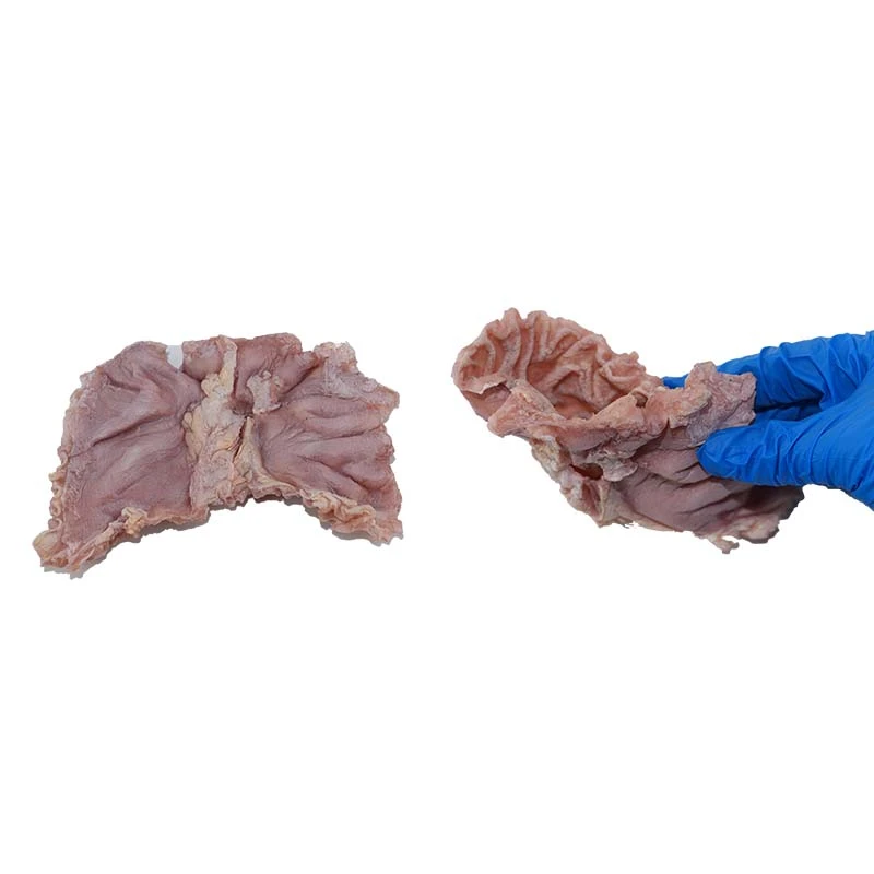 Ulcerative Gastric Cancer Ulcerative Gastric Cancer